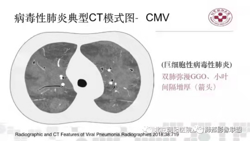 影像PPT - 【病例】透过影像识病毒—病毒性肺炎4例影像-95