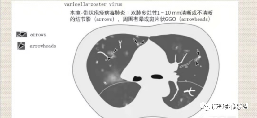 影像PPT - 【病例】透过影像识病毒—病毒性肺炎4例影像-96