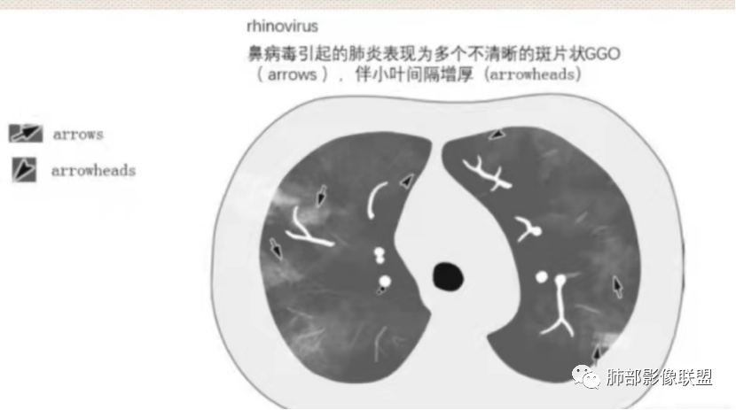 影像PPT - 【病例】透过影像识病毒—病毒性肺炎4例影像-97