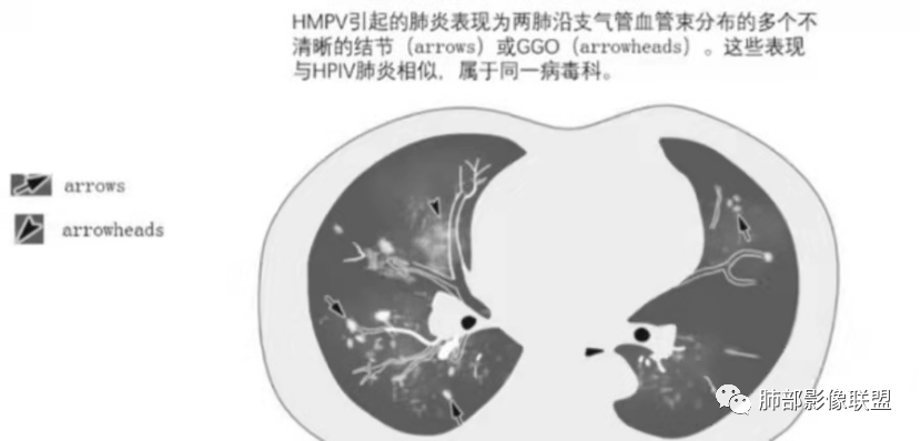 影像PPT - 【病例】透过影像识病毒—病毒性肺炎4例影像-98