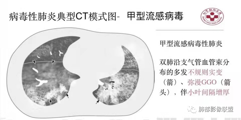 影像PPT - 【病例】透过影像识病毒—病毒性肺炎4例影像-99