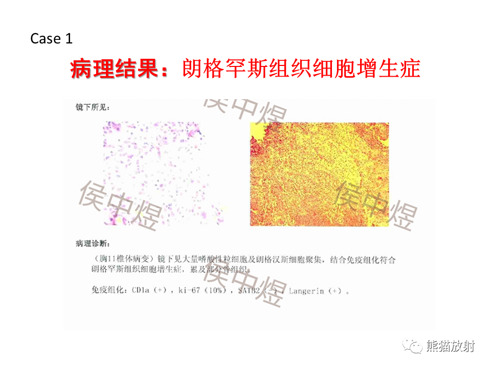 影像PPT - 【病例】脊柱嗜酸性肉芽肿 VS 骨母细胞瘤-24