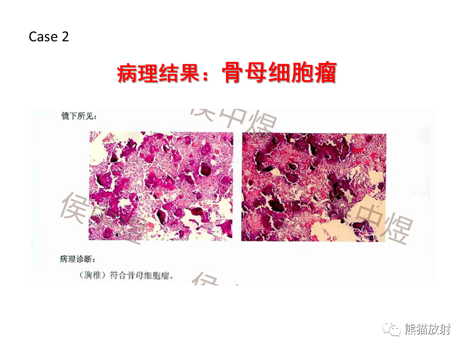 影像PPT - 【病例】脊柱嗜酸性肉芽肿 VS 骨母细胞瘤-25