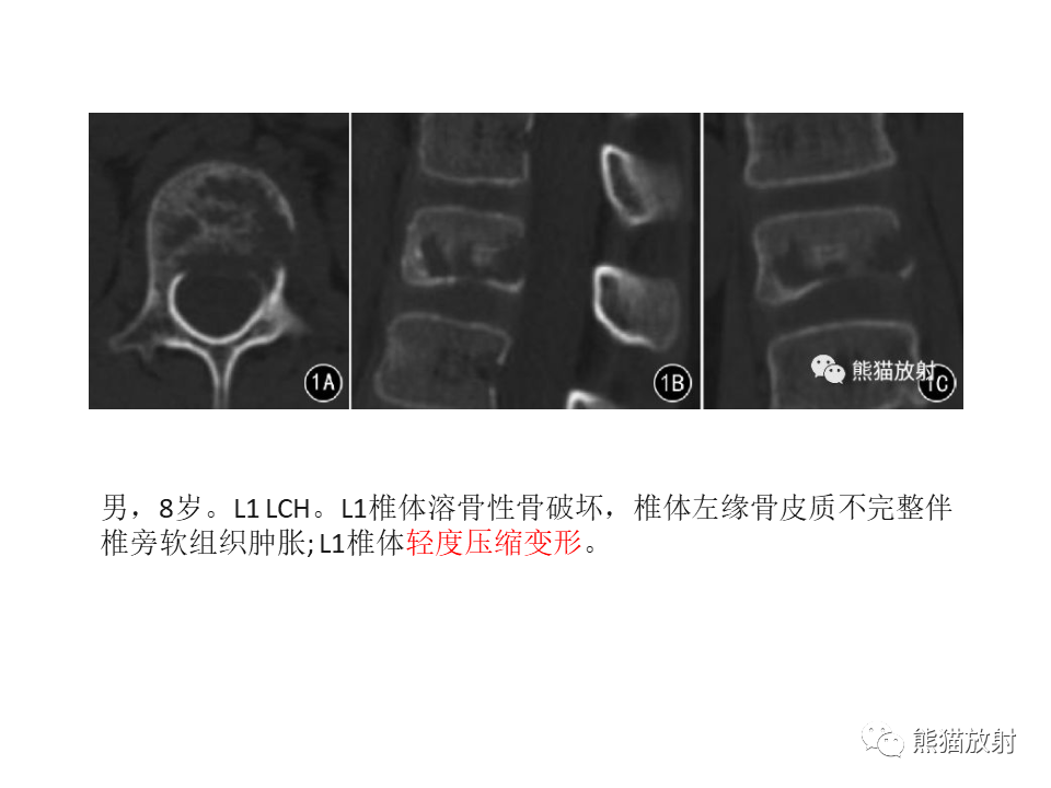 影像PPT - 【病例】脊柱嗜酸性肉芽肿 VS 骨母细胞瘤-28