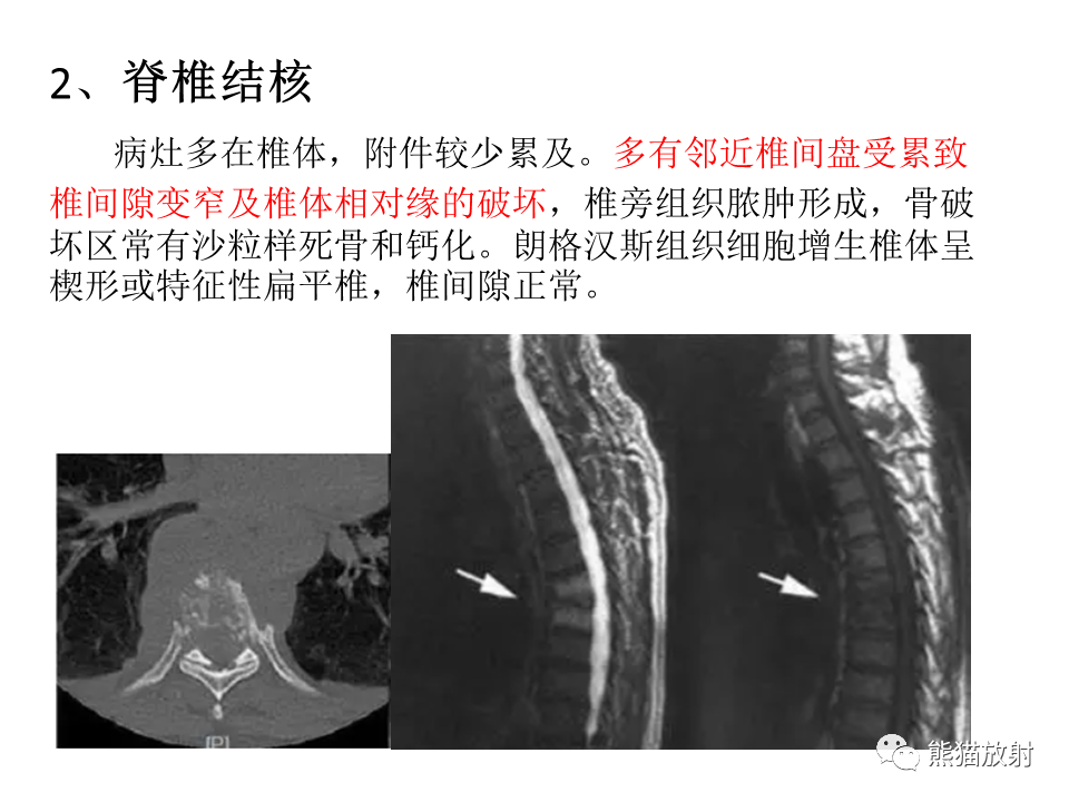 影像PPT - 【病例】脊柱嗜酸性肉芽肿 VS 骨母细胞瘤-36