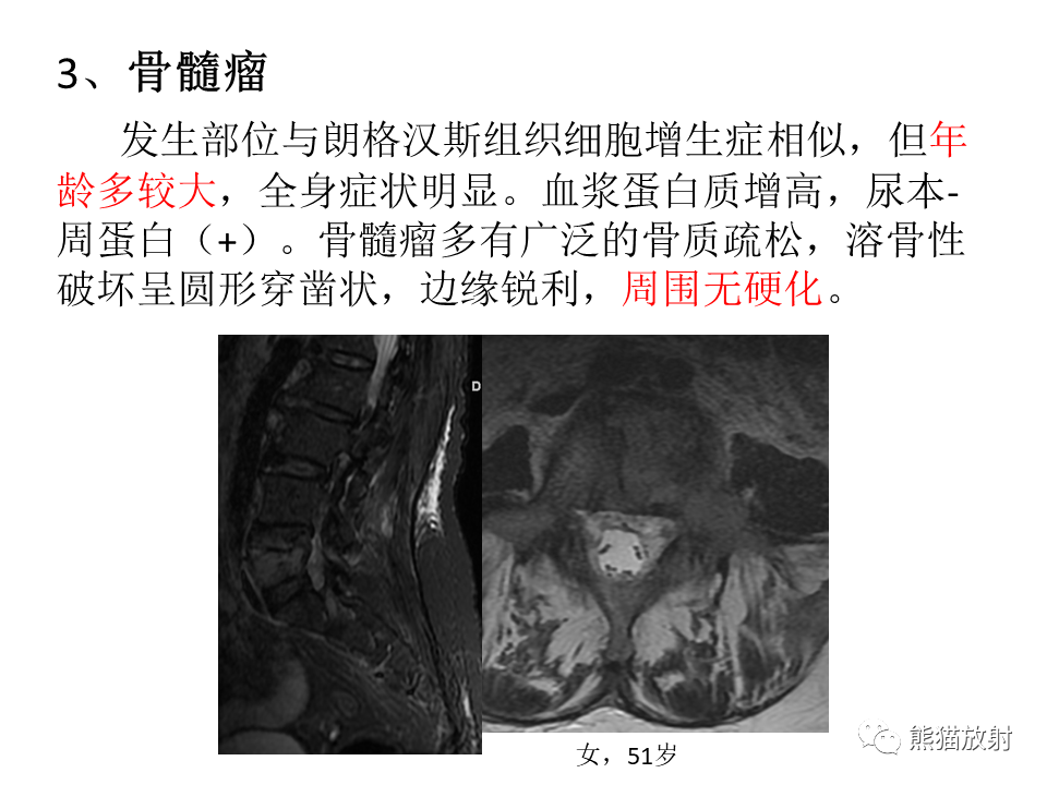 影像PPT - 【病例】脊柱嗜酸性肉芽肿 VS 骨母细胞瘤-37