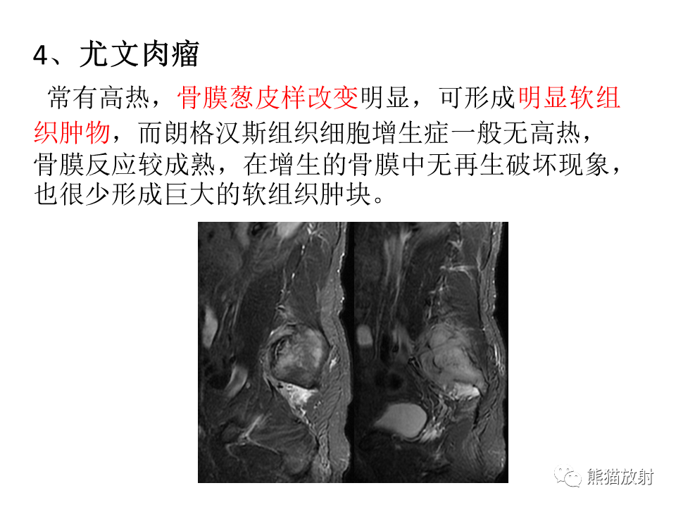 影像PPT - 【病例】脊柱嗜酸性肉芽肿 VS 骨母细胞瘤-38