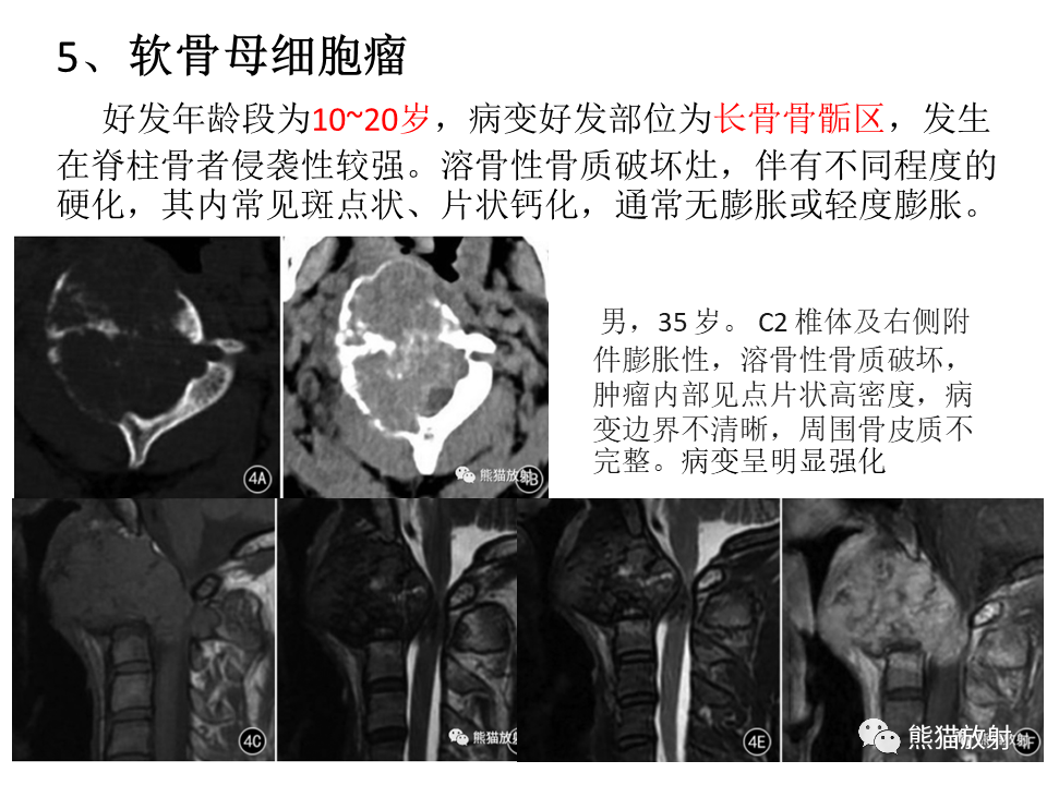 影像PPT - 【病例】脊柱嗜酸性肉芽肿 VS 骨母细胞瘤-39
