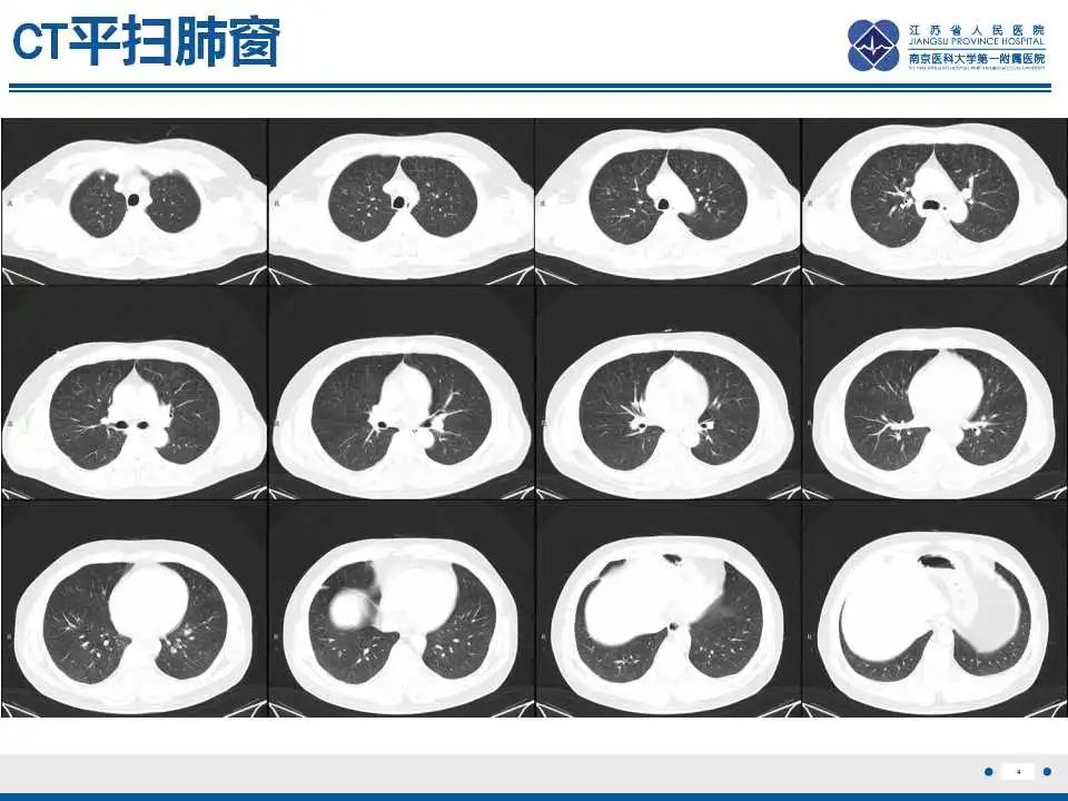 影像PPT - 【PPT】电焊工尘肺/铁尘肺-4