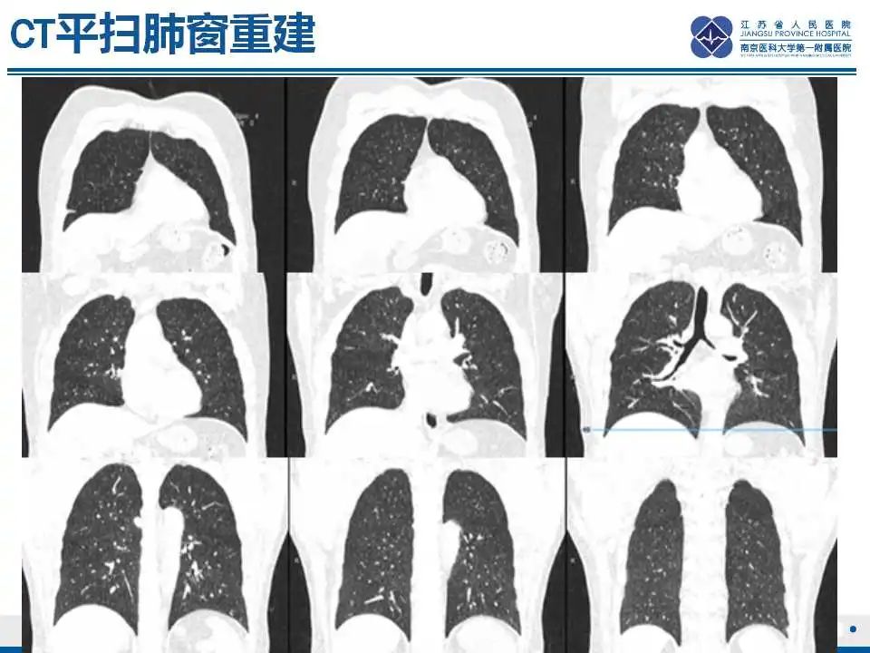 影像PPT - 【PPT】电焊工尘肺/铁尘肺-9