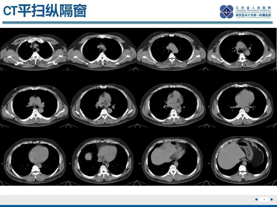 影像PPT - 【PPT】电焊工尘肺/铁尘肺-8