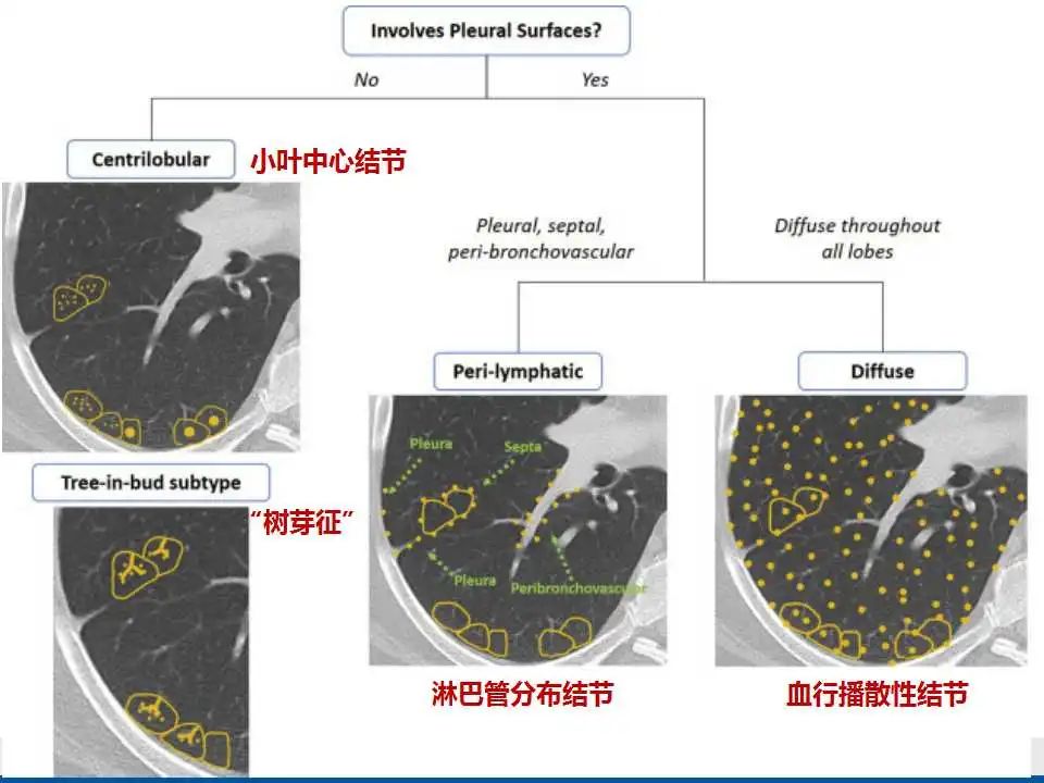 影像PPT - 【PPT】电焊工尘肺/铁尘肺-17