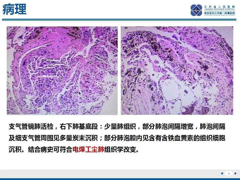 影像PPT - 【PPT】电焊工尘肺/铁尘肺-22