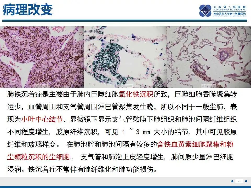 影像PPT - 【PPT】电焊工尘肺/铁尘肺-27
