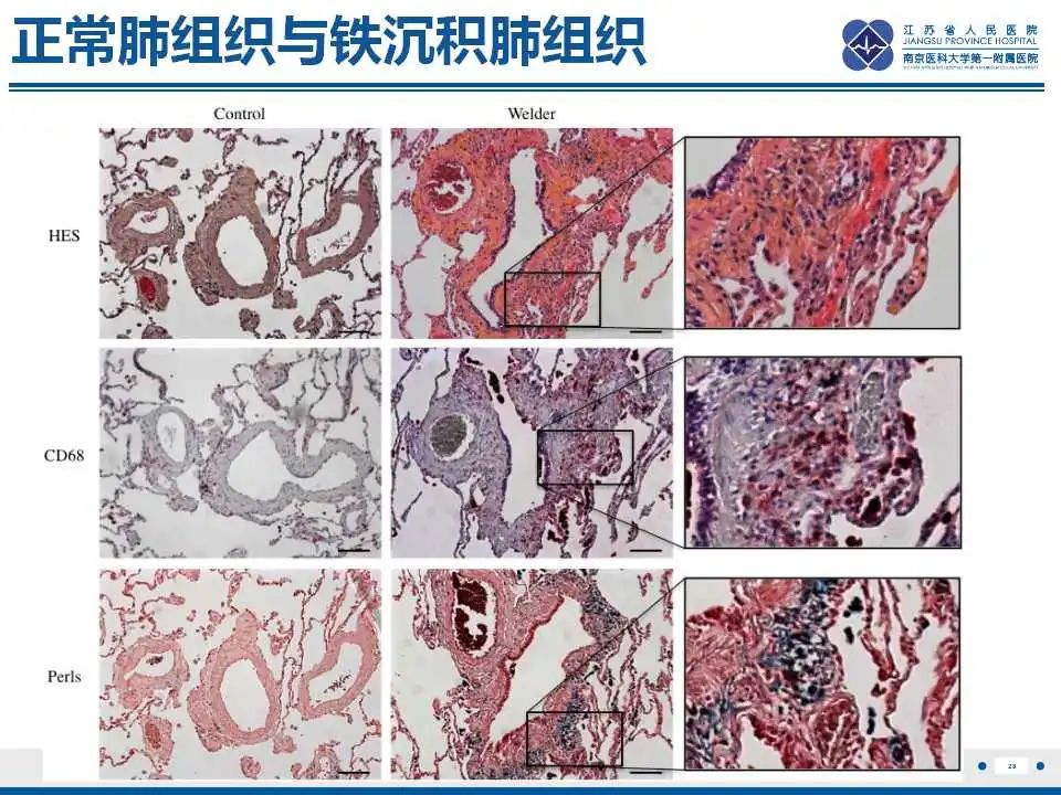 影像PPT - 【PPT】电焊工尘肺/铁尘肺-28