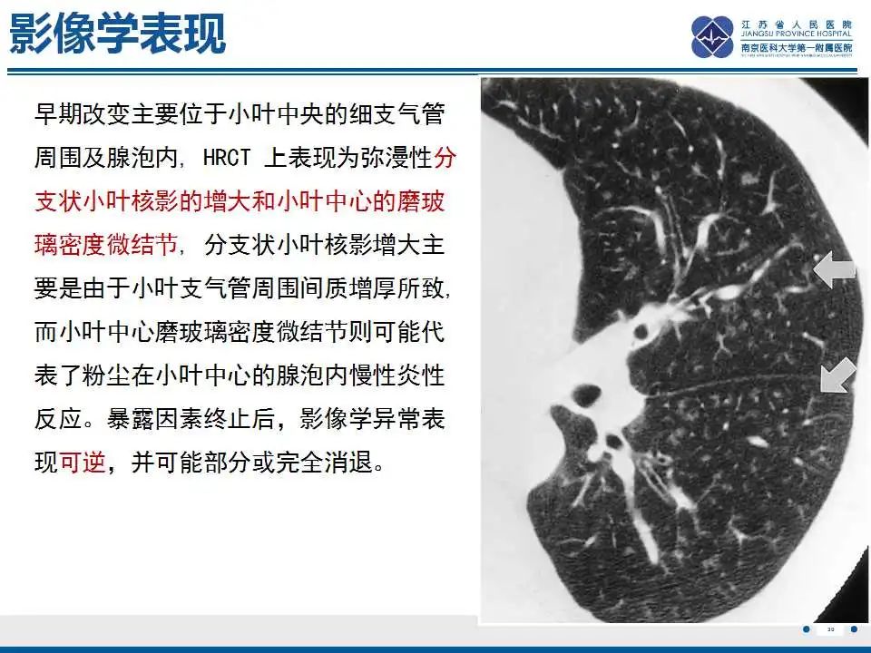 影像PPT - 【PPT】电焊工尘肺/铁尘肺-30