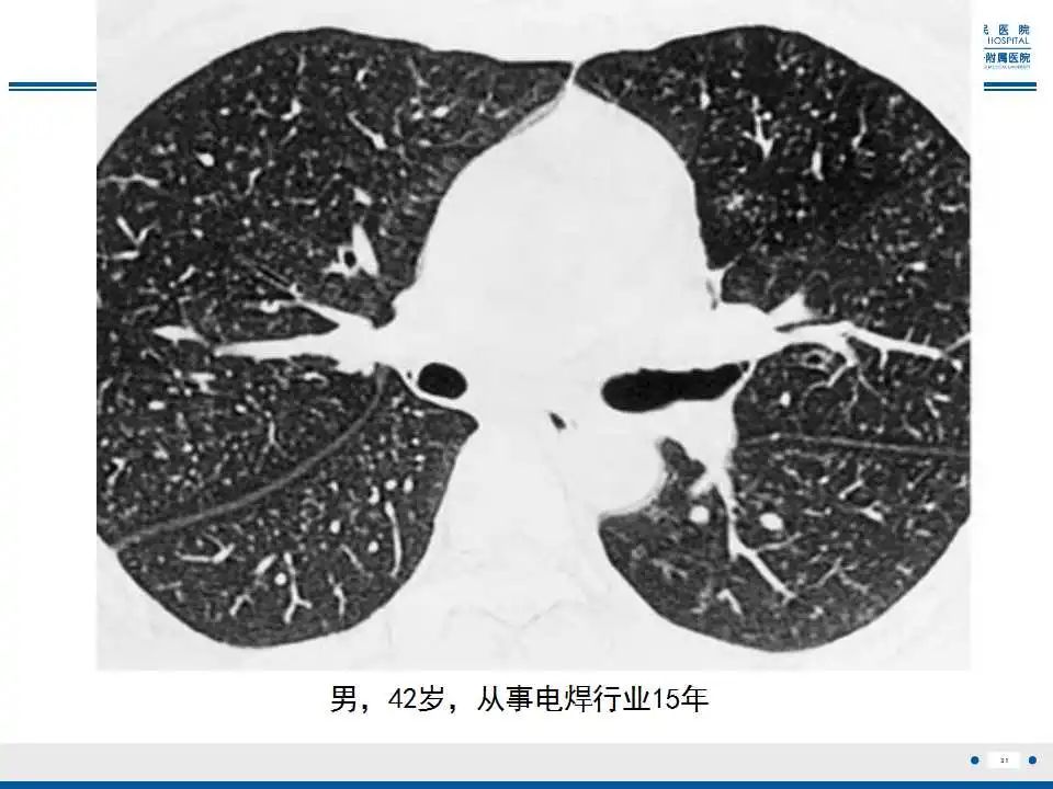 影像PPT - 【PPT】电焊工尘肺/铁尘肺-31