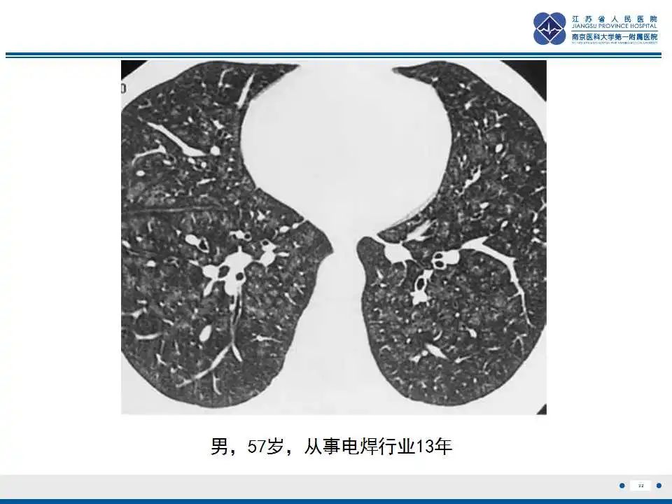 影像PPT - 【PPT】电焊工尘肺/铁尘肺-32
