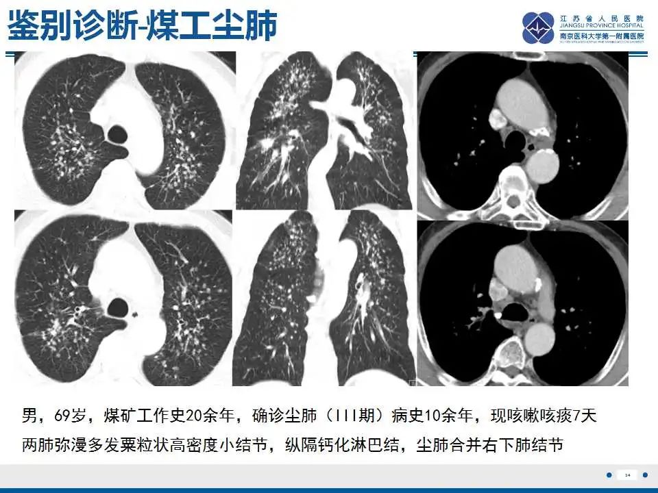 影像PPT - 【PPT】电焊工尘肺/铁尘肺-34