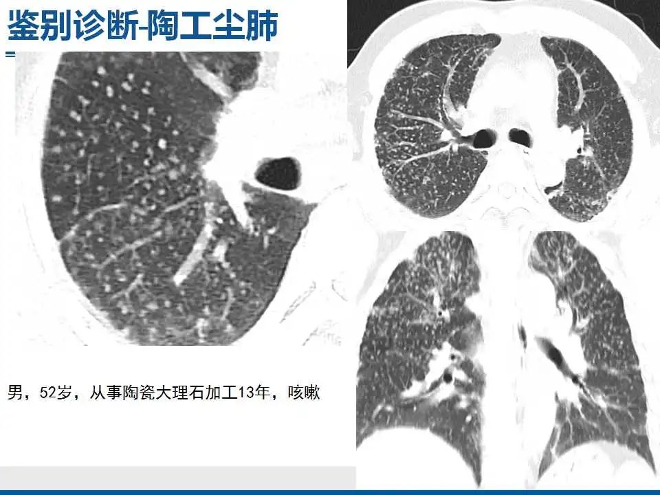 影像PPT - 【PPT】电焊工尘肺/铁尘肺-35