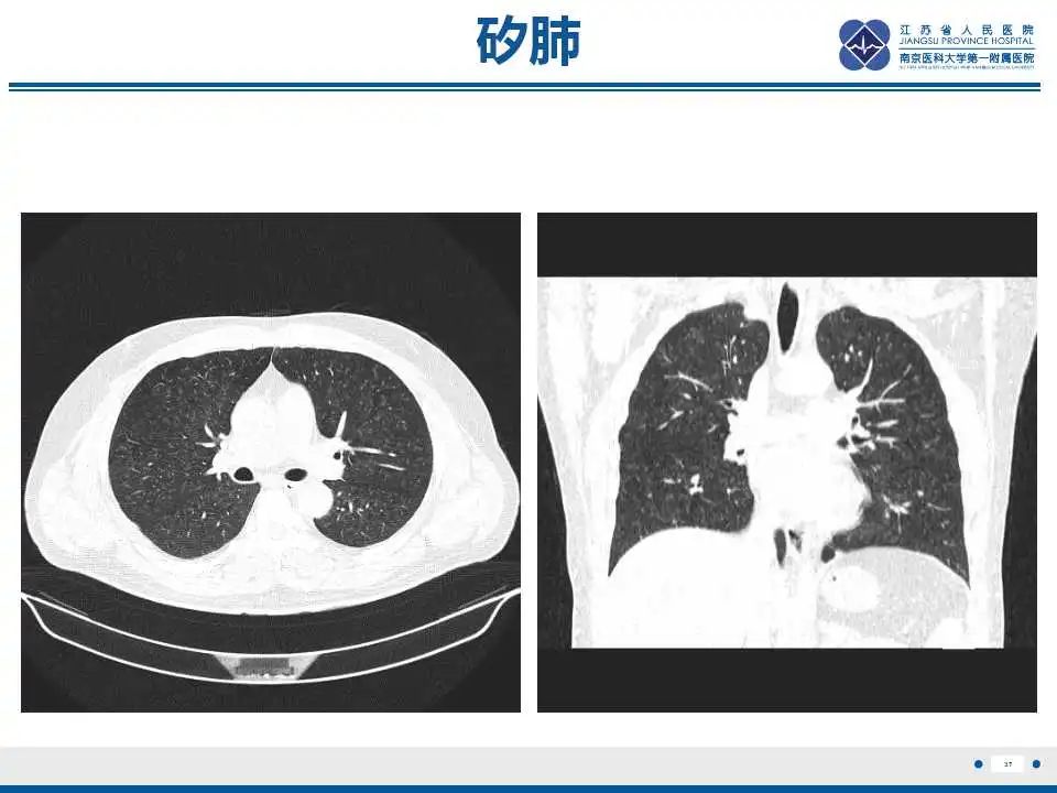 影像PPT - 【PPT】电焊工尘肺/铁尘肺-37