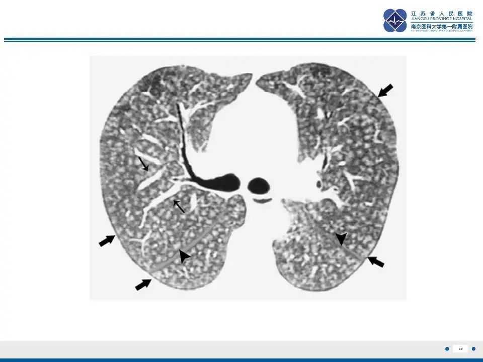 影像PPT - 【PPT】电焊工尘肺/铁尘肺-39