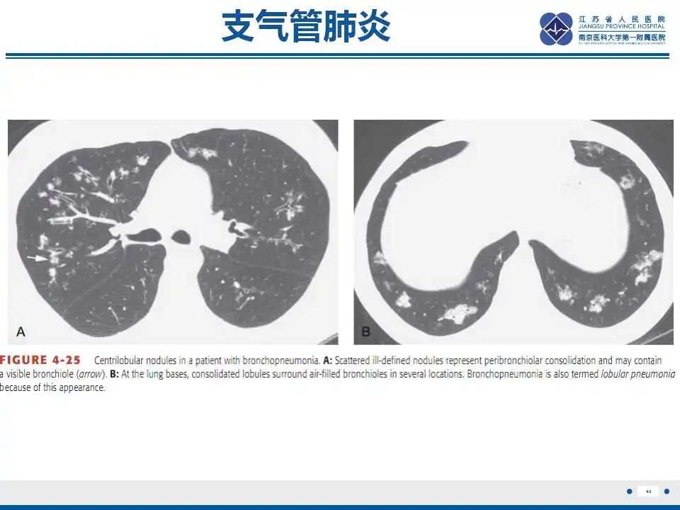 影像PPT - 【PPT】电焊工尘肺/铁尘肺-40