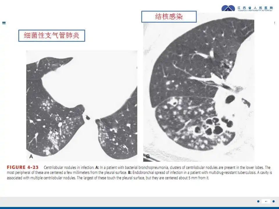 影像PPT - 【PPT】电焊工尘肺/铁尘肺-41