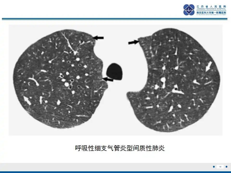 影像PPT - 【PPT】电焊工尘肺/铁尘肺-42