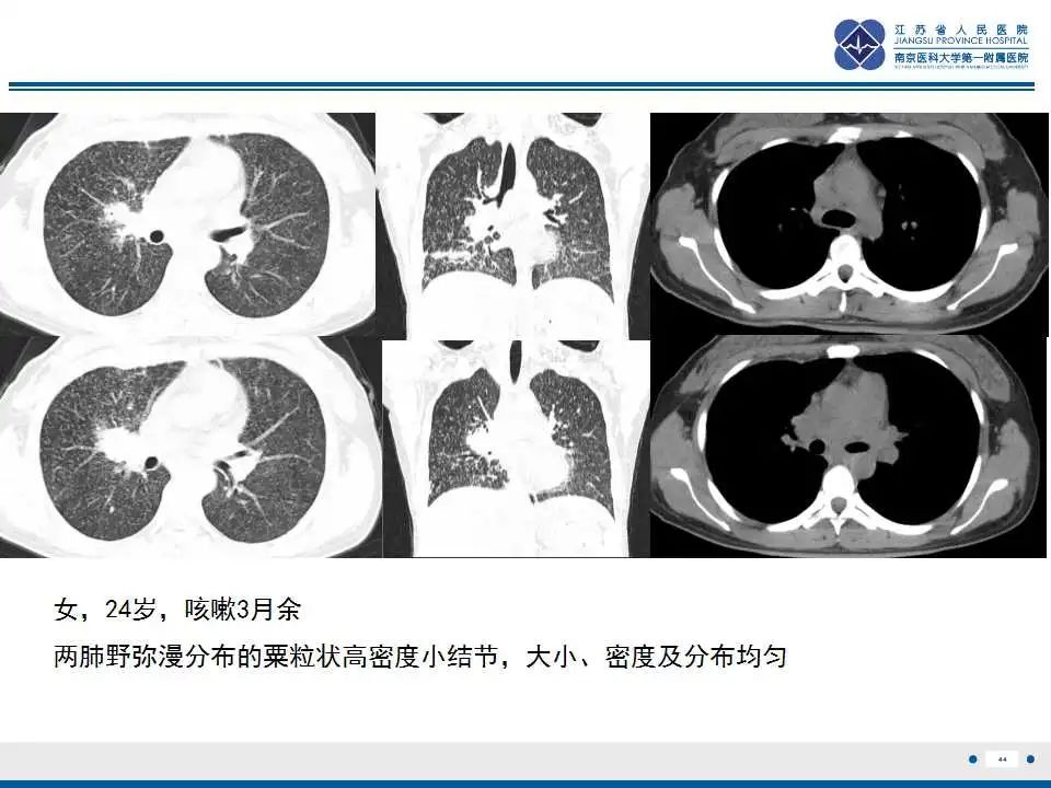 影像PPT - 【PPT】电焊工尘肺/铁尘肺-44