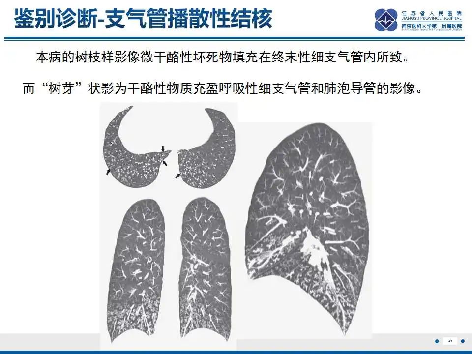 影像PPT - 【PPT】电焊工尘肺/铁尘肺-45