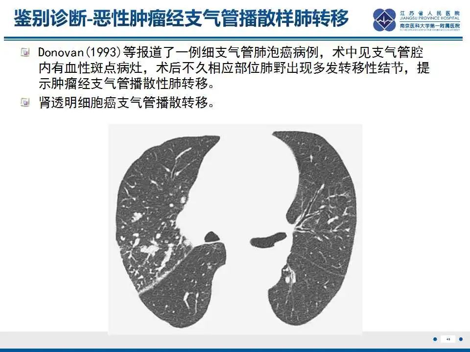 影像PPT - 【PPT】电焊工尘肺/铁尘肺-46