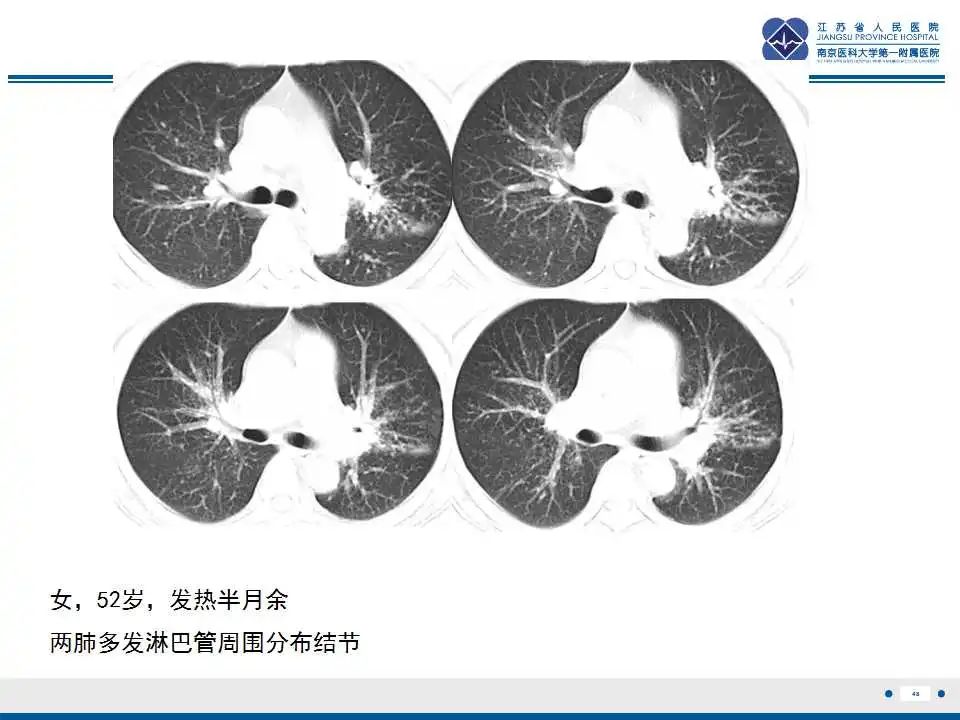 影像PPT - 【PPT】电焊工尘肺/铁尘肺-48