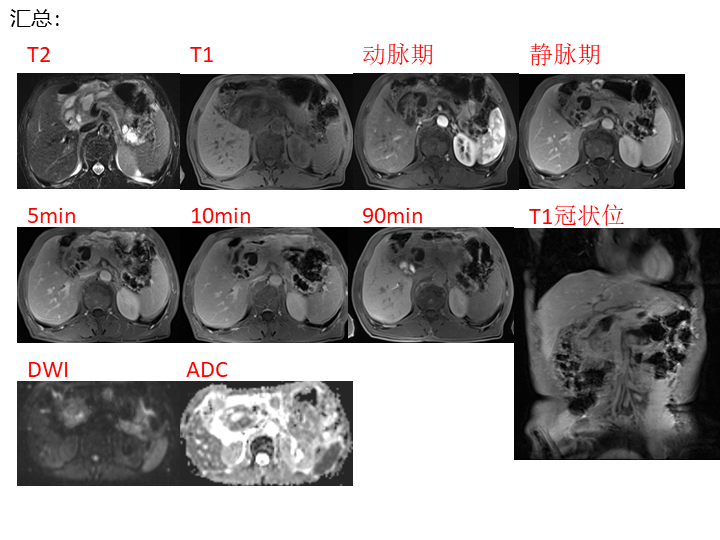影像PPT - 【病例】胰腺导管内乳头状粘液瘤 VS 慢性胰腺炎-12
