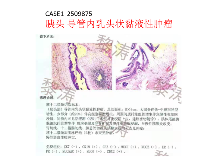 影像PPT - 【病例】胰腺导管内乳头状粘液瘤 VS 慢性胰腺炎-27