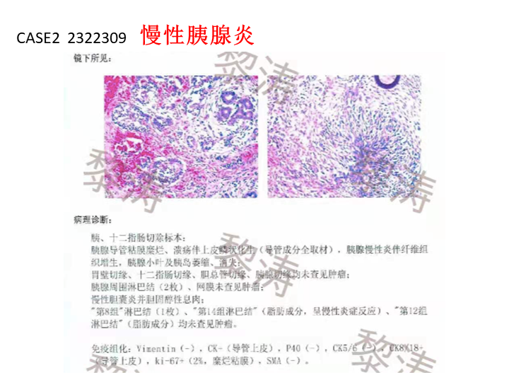 影像PPT - 【病例】胰腺导管内乳头状粘液瘤 VS 慢性胰腺炎-28