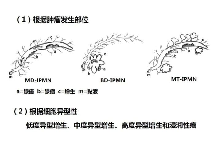 影像PPT - 【病例】胰腺导管内乳头状粘液瘤 VS 慢性胰腺炎-32