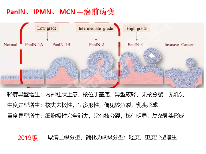 影像PPT - 【病例】胰腺导管内乳头状粘液瘤 VS 慢性胰腺炎-34