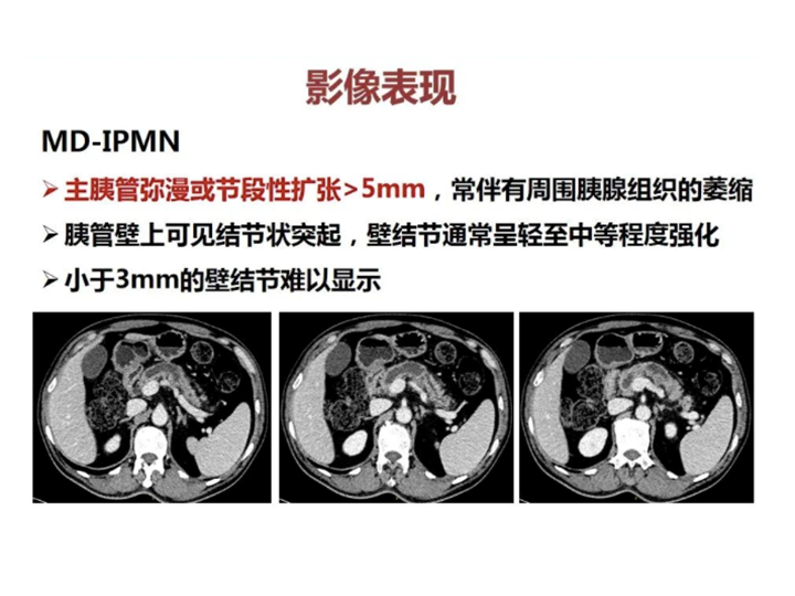 影像PPT - 【病例】胰腺导管内乳头状粘液瘤 VS 慢性胰腺炎-36