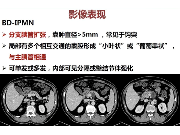 影像PPT - 【病例】胰腺导管内乳头状粘液瘤 VS 慢性胰腺炎-37