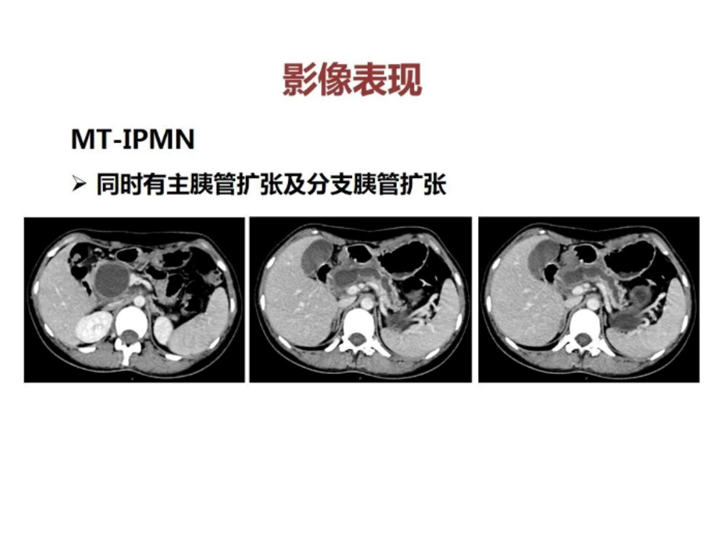 影像PPT - 【病例】胰腺导管内乳头状粘液瘤 VS 慢性胰腺炎-38
