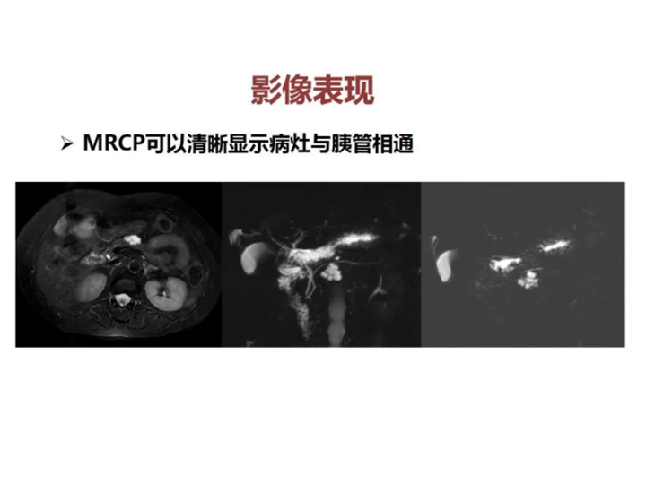 影像PPT - 【病例】胰腺导管内乳头状粘液瘤 VS 慢性胰腺炎-39