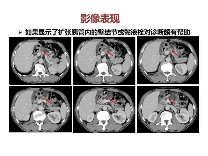 影像PPT - 【病例】胰腺导管内乳头状粘液瘤 VS 慢性胰腺炎-40