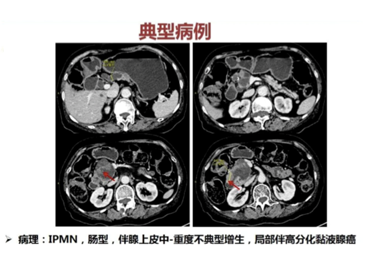 影像PPT - 【病例】胰腺导管内乳头状粘液瘤 VS 慢性胰腺炎-41