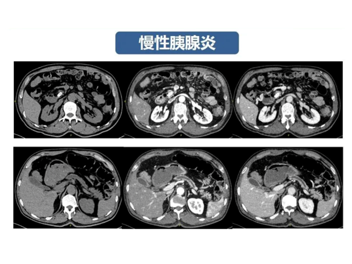 影像PPT - 【病例】胰腺导管内乳头状粘液瘤 VS 慢性胰腺炎-43