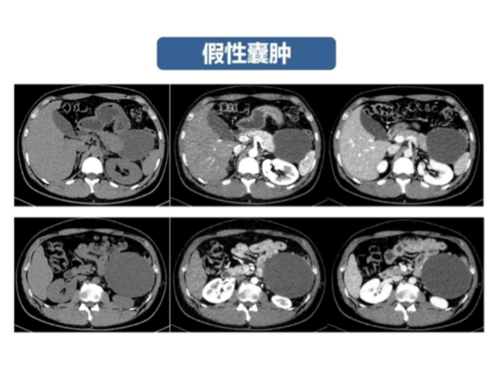 影像PPT - 【病例】胰腺导管内乳头状粘液瘤 VS 慢性胰腺炎-45