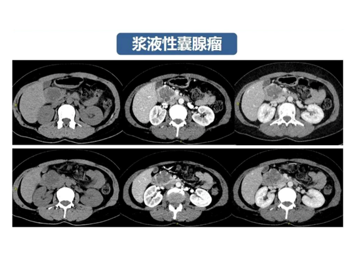影像PPT - 【病例】胰腺导管内乳头状粘液瘤 VS 慢性胰腺炎-47