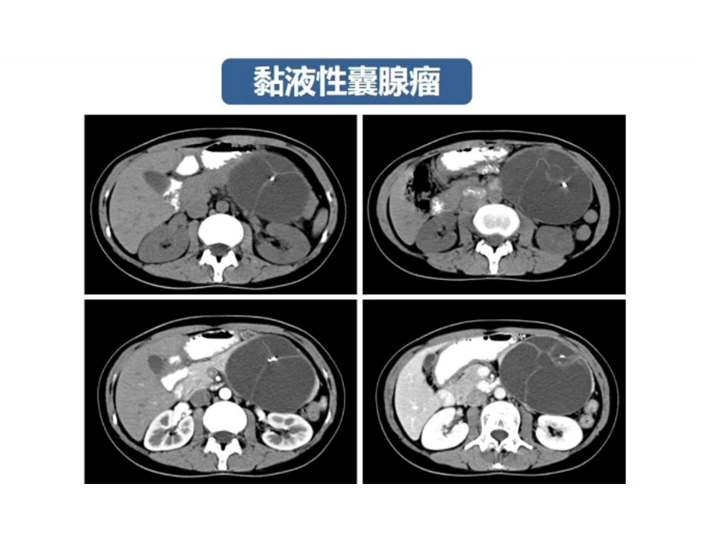 影像PPT - 【病例】胰腺导管内乳头状粘液瘤 VS 慢性胰腺炎-49