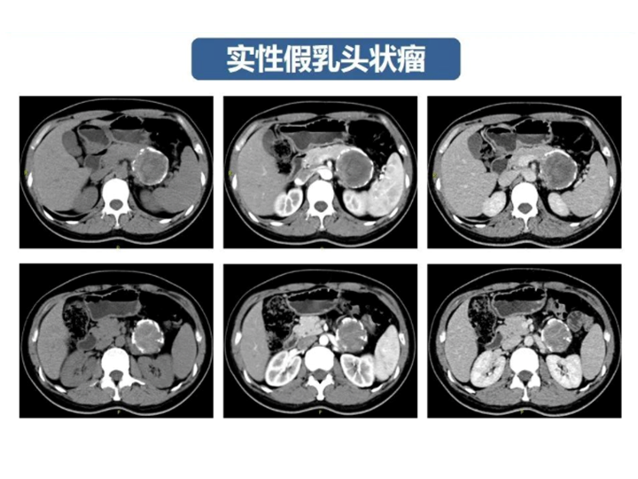 影像PPT - 【病例】胰腺导管内乳头状粘液瘤 VS 慢性胰腺炎-51