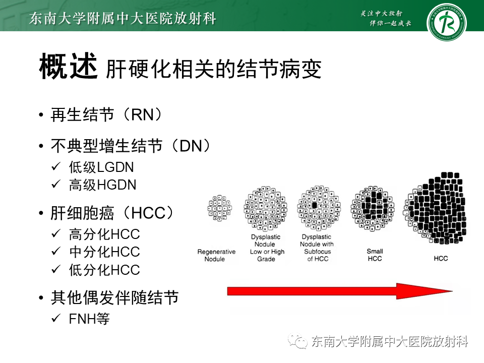 影像PPT - 【PPT】肝硬化结节和早期肝癌的MRI诊断和鉴别-8